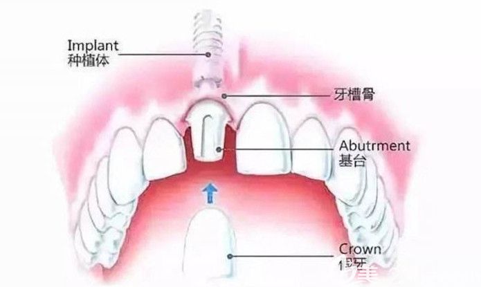 牙齒種植修復(fù)過程