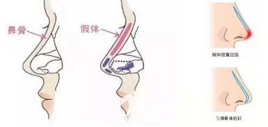 討論因為皮膚太薄、操作不當、和炎癥引起的隆鼻后假體透光的解決方法