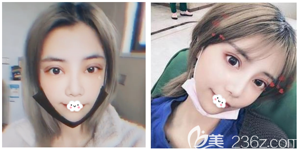 看深圳美萊林登文雙眼皮修復(fù)一個(gè)月效果怎么樣 看深圳美萊林登文雙眼皮修復(fù)一個(gè)月效果怎么樣