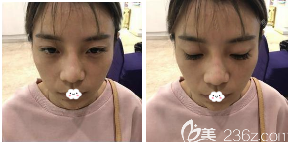 去深圳美萊做雙眼皮修復(fù)術(shù)前照片 去深圳美萊做雙眼皮修復(fù)術(shù)前照片