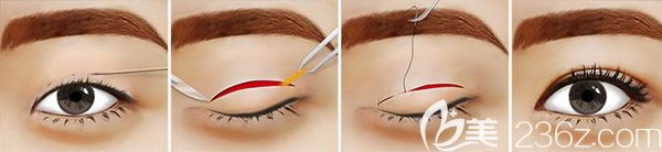 切開雙眼皮手術(shù)原理