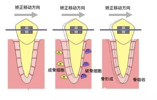 牙齒矯正中移動方向