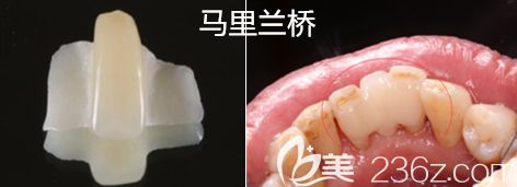 馬里蘭橋圖解 馬里蘭橋圖解