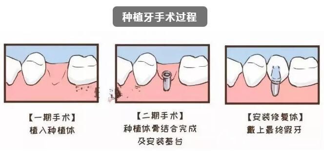 種植牙術(shù)后注意事項(xiàng) 種植牙術(shù)后注意事項(xiàng)