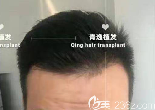 種植2300毛囊單位后我成功告別M型脫發(fā)，半年就梳起了大背頭