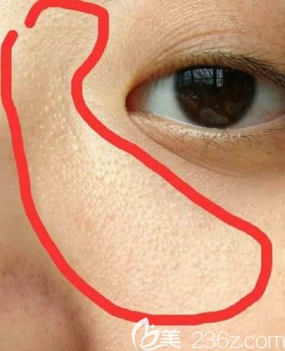 眼周長(zhǎng)出來(lái)的顆粒