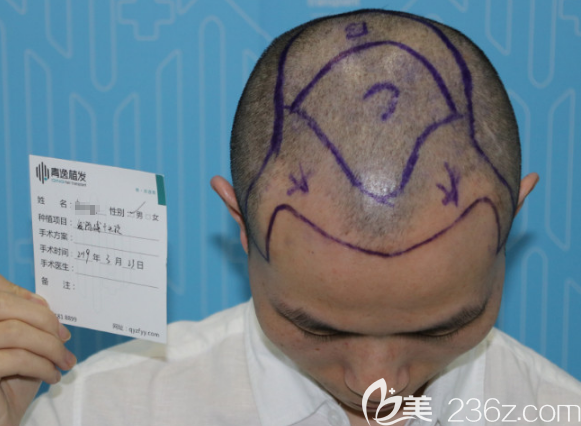 醫(yī)生設(shè)計(jì)方案:發(fā)際線種植+頭頂加密 醫(yī)生設(shè)計(jì)方案:發(fā)際線種植+頭頂加密