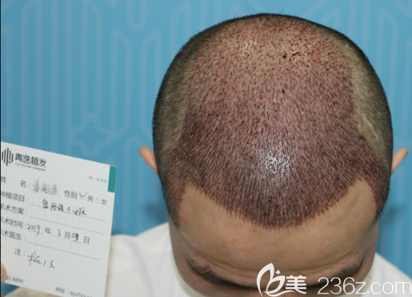 頭發(fā)種植3000單位術(shù)后即刻照片 頭發(fā)種植3000單位術(shù)后即刻照片