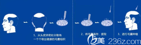 頭發(fā)種植手術(shù)的原理圖 頭發(fā)種植手術(shù)的原理圖