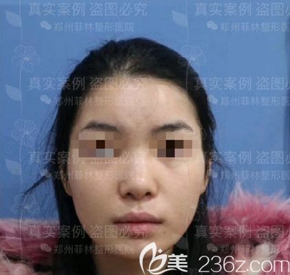 假體隆鼻手術(shù)前 假體隆鼻手術(shù)前