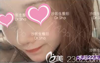 做完自體軟骨隆鼻+脂肪面部填充術(shù)后22天恢復(fù)效果