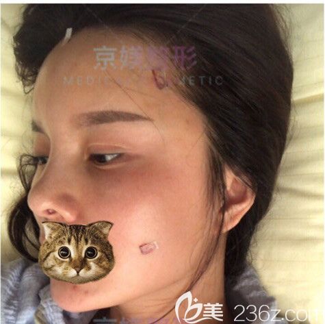 剛做完脂肪填充術后面部微腫