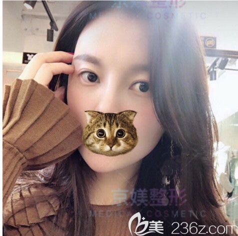 脂肪填充面部術后20天基本恢復