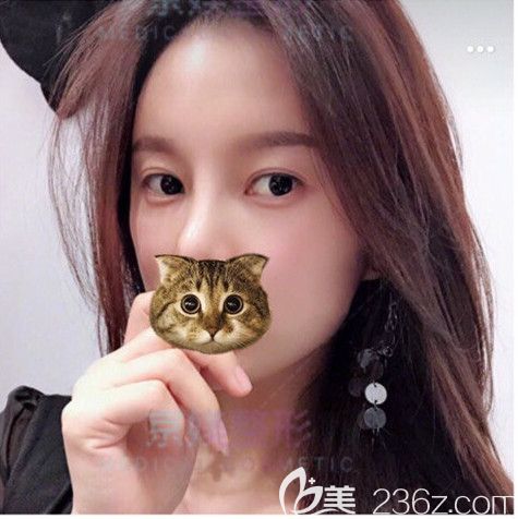 自體脂肪填充術(shù)后不僅太陽(yáng)穴、蘋(píng)果肌變飽滿 就連顯老的淚溝也不見(jiàn)了