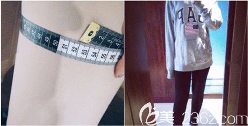 吸脂瘦大腿23天后明顯變化 吸脂瘦大腿23天后明顯變化