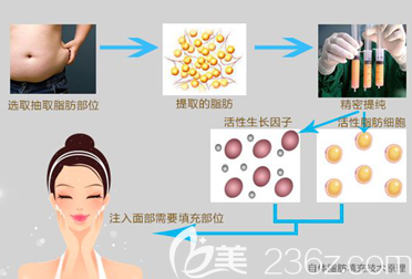 自體脂肪填充手術(shù)過程