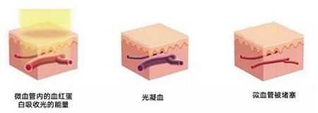 染料激光去紅血絲的原理