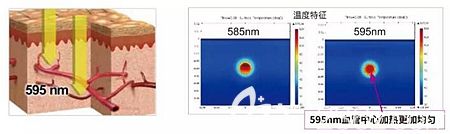 595染料激光要比585更有優(yōu)勢(shì)