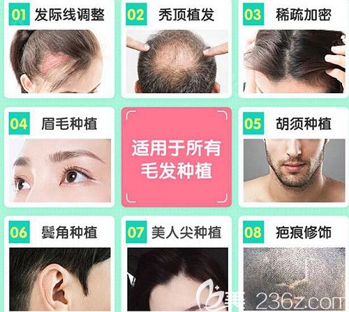韓妃植發(fā)適用于所有毛發(fā)種植