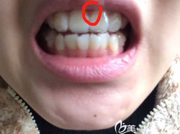 中間牙齦很悶