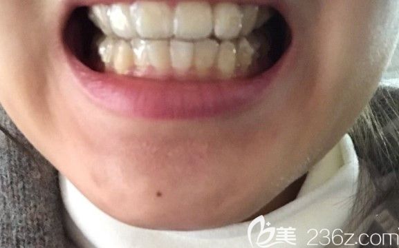 戴微笑隱形牙套2個月啦