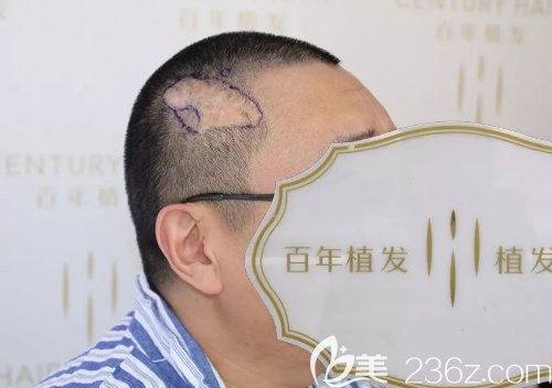 伴隨沈先生46年的胎記疤痕 伴隨沈先生46年的胎記疤痕