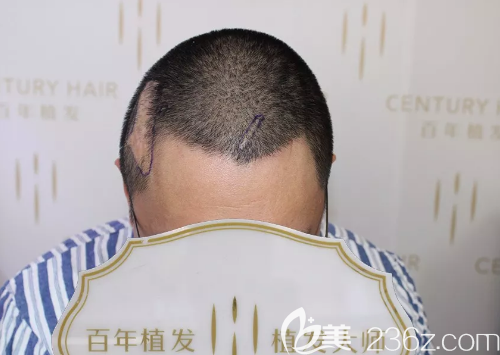 沈先生來院后醫(yī)生檢查了毛囊情況及疤痕部位的血運情況 沈先生來院后醫(yī)生檢查了毛囊情況及疤痕部位的血運情況