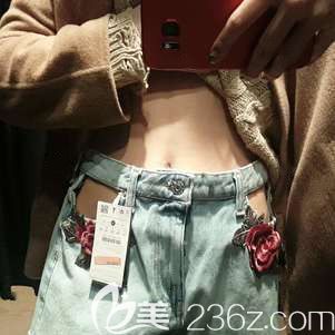 腰腹吸脂術(shù)后21天腫脹漸消 腰腹吸脂術(shù)后21天腫脹漸消