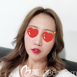 脂肪填充面部術后43天腫脹消除