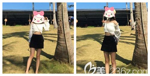 大象腿抽脂1500ml后瘦了3cm 真心覺得想要效果好在恢復(fù)期還得堅持穿塑腿褲