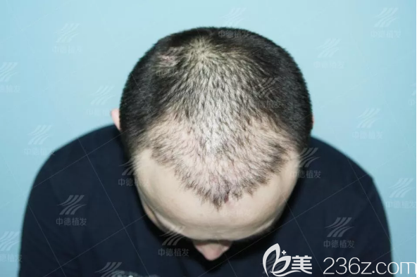 2次失敗的植發(fā)手術(shù)后效果 2次失敗的植發(fā)手術(shù)后效果