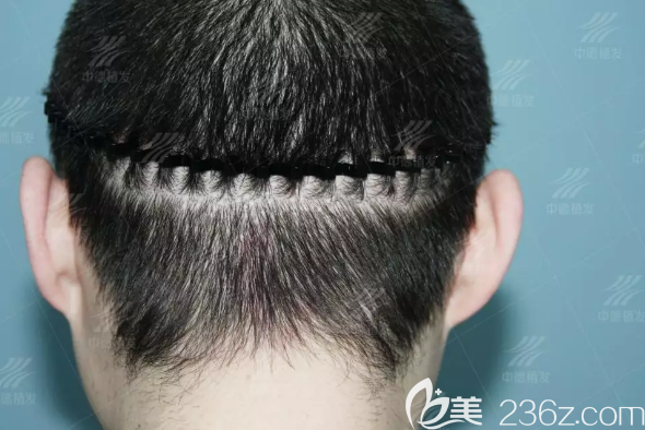 植發(fā)修復(fù)手術(shù)后沈先生后腦勺的疤痕基本不見了 植發(fā)修復(fù)手術(shù)后沈先生后腦勺的疤痕基本不見了