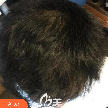 術(shù)后7個(gè)月頭發(fā)變的又長(zhǎng)又濃密 術(shù)后7個(gè)月頭發(fā)變的又長(zhǎng)又濃密