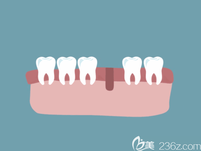 種植牙流程動(dòng)態(tài)示意圖 種植牙流程動(dòng)態(tài)示意圖