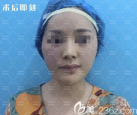 做完面部埋線提升手術(shù)后即刻