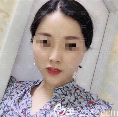 做完面部埋線提升手術(shù)15天