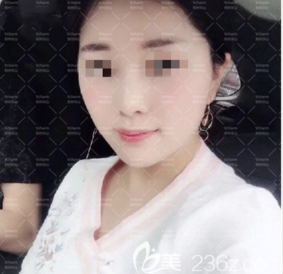 不私藏來分享我做的面部埋線提升手術后并沒有你們想象中老的那么快