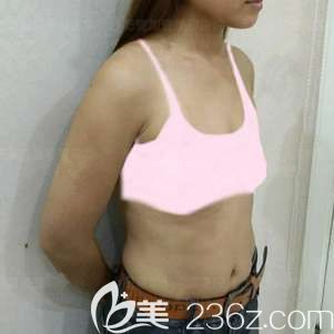 手術(shù)前自己平坦的胸 手術(shù)前自己平坦的胸