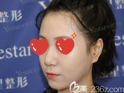 手術(shù)前鼻子上的小駝峰 手術(shù)前鼻子上的小駝峰