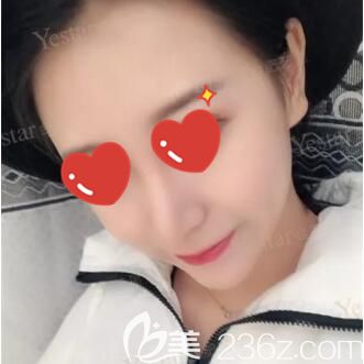 駝峰鼻矯正術(shù)后15天腫脹消除 駝峰鼻矯正術(shù)后15天腫脹消除