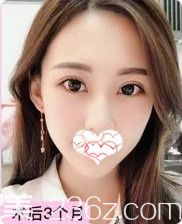 只有做一次眼綜合手術才能體會到一雙網紅大眼的魅力