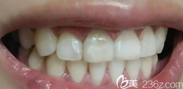 經(jīng)過一年2個月的時候牙齒終于矯正好了