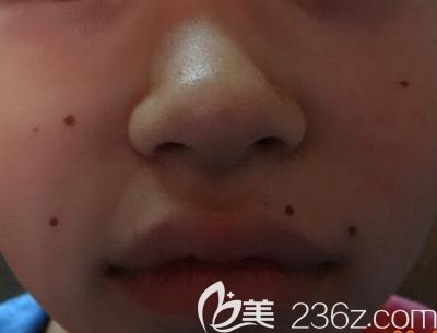 激光可以去除臉上的黑痣