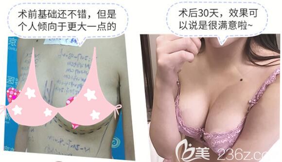 娜綺麗假體隆胸術(shù)后30天
