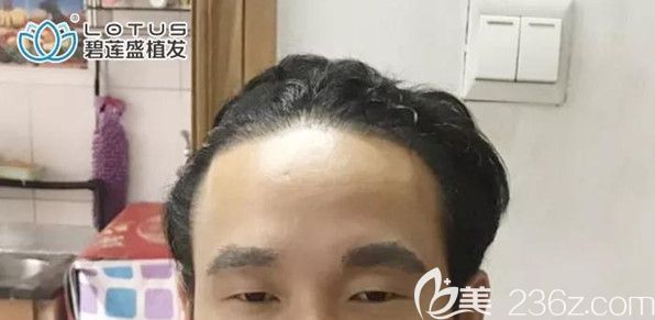 前額發(fā)際線種植1年了，我想跟大家嘮嘮”植發(fā)完又脫發(fā)“的那些事兒