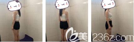 術(shù)前大腿粗壯 術(shù)前大腿粗壯