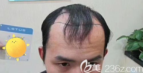 術前前額大面積脫發(fā)