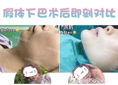 陌陌做硅膠墊下巴術(shù)后即刻效果 陌陌做硅膠墊下巴術(shù)后即刻效果