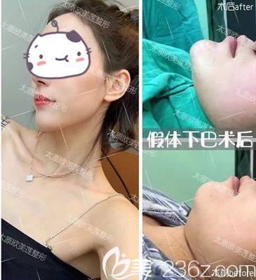 擔(dān)心硅膠墊下巴術(shù)后容易被看穿，別著急先來(lái)看看她們?cè)趺凑f(shuō)