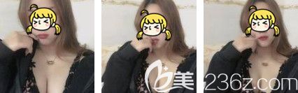 ES假體豐胸術(shù)后1個月胸部基本恢復 ES假體豐胸術(shù)后1個月胸部基本恢復